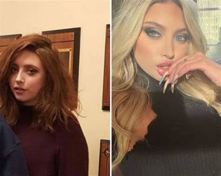 Ava Louise before and after surgery photo
