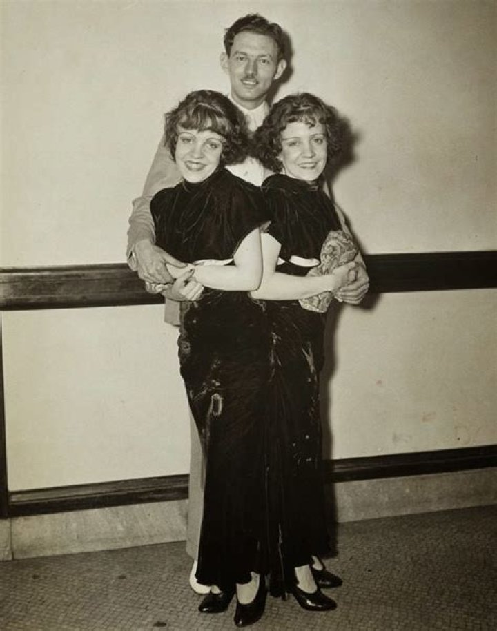 Conjoined Hilton Sisters