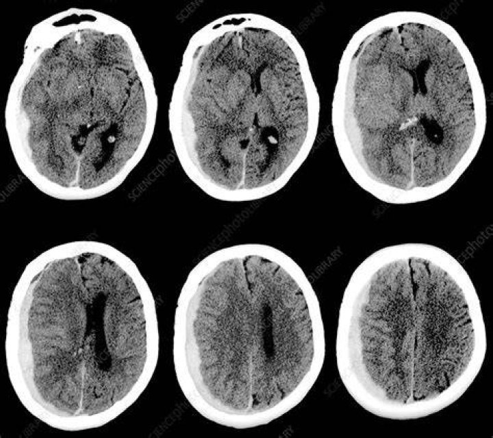 CT Scans Of Subdural Hematoma