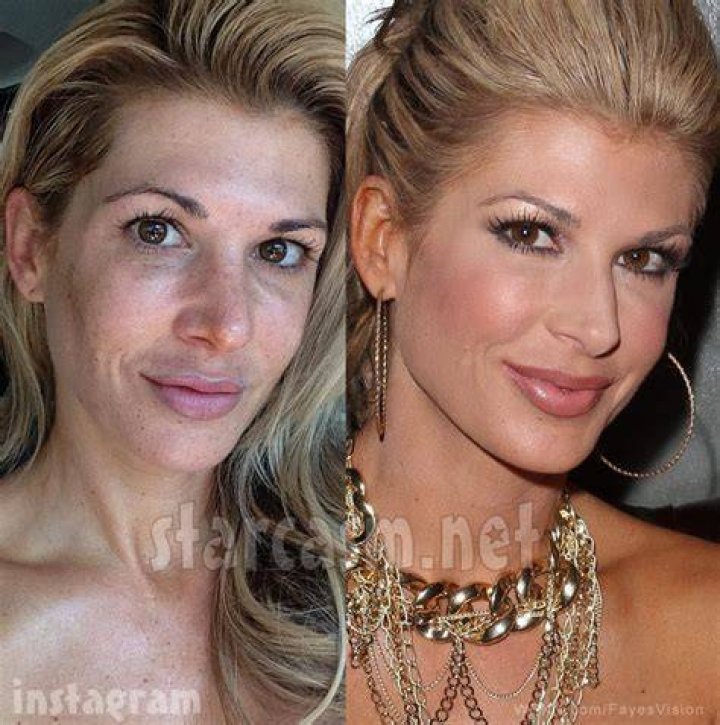 Housewives plastic surgery alexis bellino