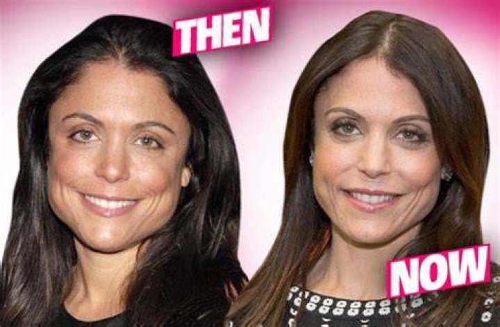Housewives plastic surgery bethenny frankel