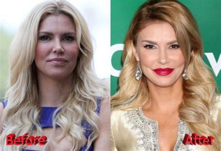 Housewives plastic surgery brandi glanville