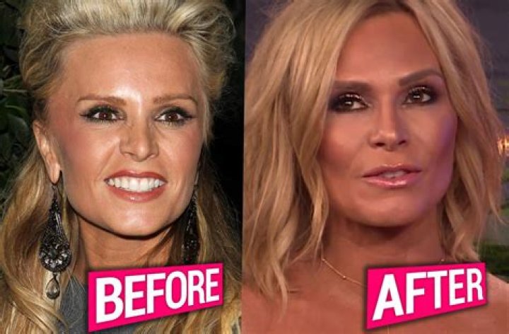 Housewives plastic surgery tamra judge