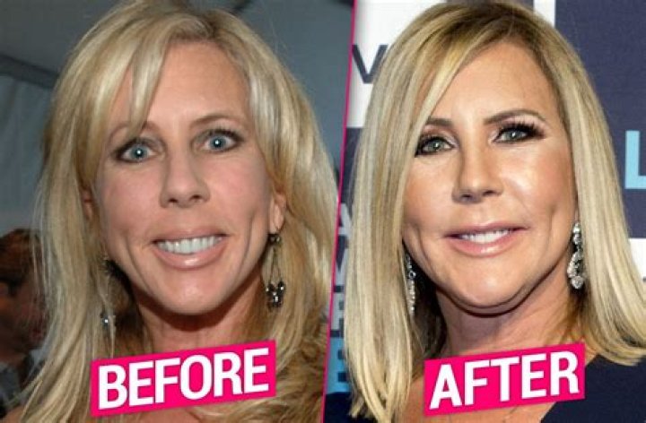 Housewives plastic surgery vicki gunvalson