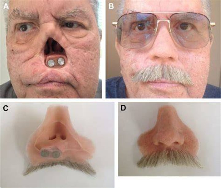 Nose Prosthesis